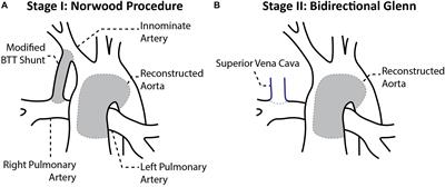 Characterization of Post-Operative Hemodynamics Following the Norwood Procedure Using Population Data and Multi-Scale Modeling